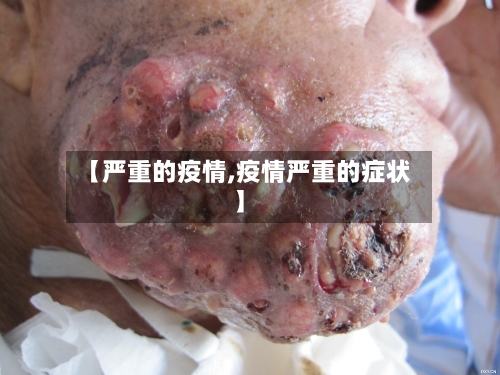 【严重的疫情,疫情严重的症状】-第2张图片